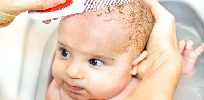 All you need to know about baby cradle cap and what causes it