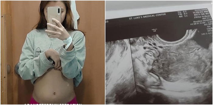 REAL STORIES: "The doctors removed my left ovary. I was worried if I'll ever be pregnant."