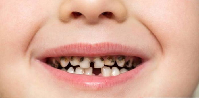 Why is my baby's teeth gray? Is it baby tooth decay?