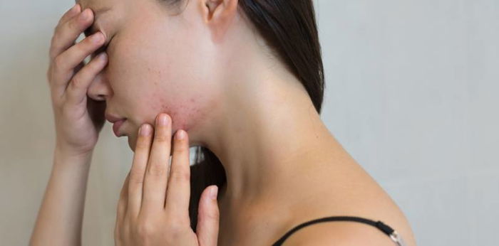 Postpartum acne: Why do I have it and how can I treat it?