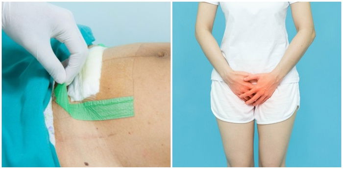 Mom's guide on how to care for your postpartum wound - vaginal or cesarean delivery