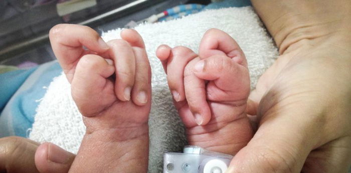 Ano ang Edwards Syndrome? Alamin ang sanhi at sintomas ng sakit na ito