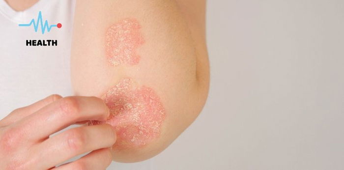Is Eczema contagious? Causes, treatment, and all you need to know