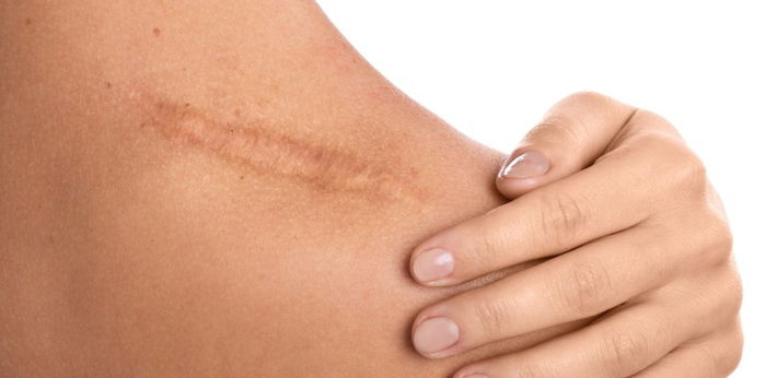 Sebo De Macho for Scars? Kwow the uses, benefits, and treatment for scars