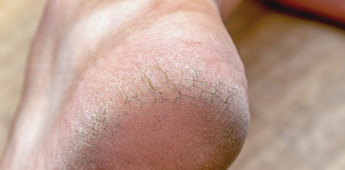 8 home remedies para mawala ang kalyo sa paa