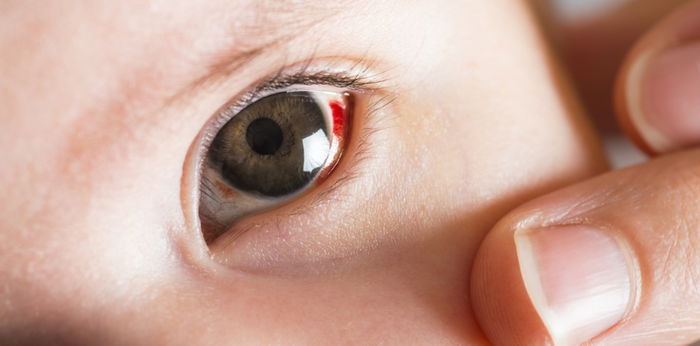 Subconjunctival hemorrhage in newborns: What it is and when to call the doctor