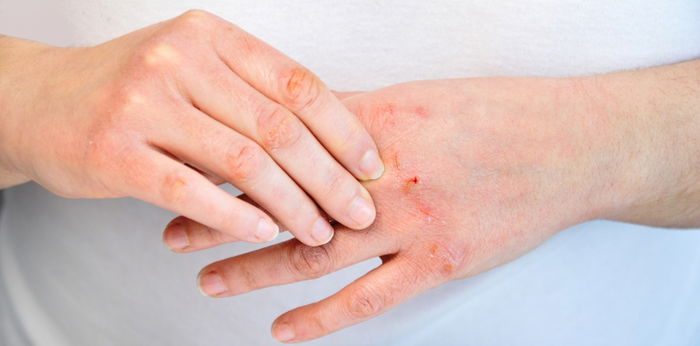 May sugat sa kamay dulot ng eczema? 7 home remedies sa sugat sa kamay