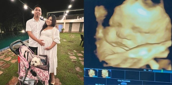 Viy Cortez nagdesisyon na sumalang sa Caesarean section delivery: "Natatakot ako na mag-normal."