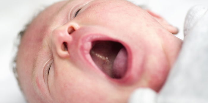 Epstein pearls in babies: What is it and how to treat it