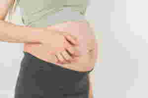 Nakakabahalang Stretch Mark Habang Nagbubuntis: Ano Ang Mabisang Pangtanggal Ng Stretch Mark?