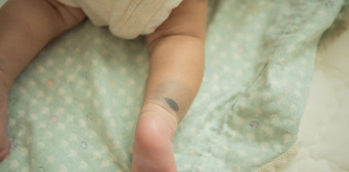 Birthmark on baby: Birthmark types and birthmark removal