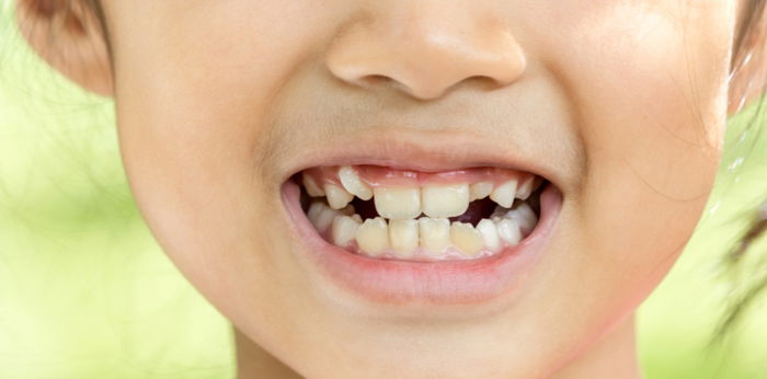 8 na posibleng sanhi sa pagkakaroon ng sungki na ngipin at paano ito maaayos