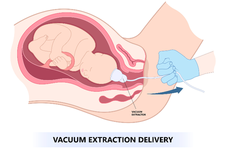 vacuum assisted delivery procedure