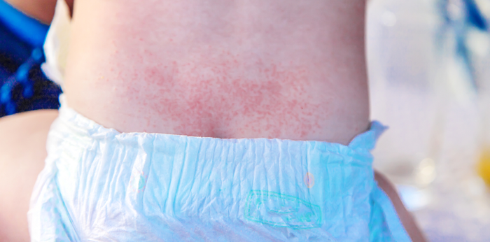 Diaper rash: 6 types of diaper rash and their treatment
