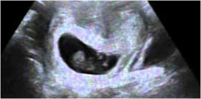 What is vanishing twin syndrome: Causes, symptoms and diagnosis