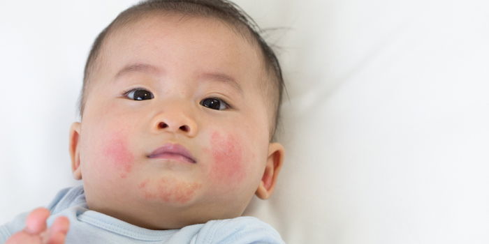 Baby Eczema: What you need to know about tending to baby's skin