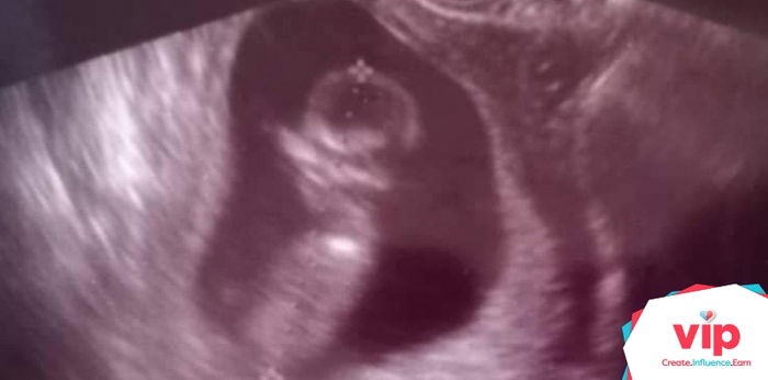 Our Miracle Pregnancy Journey