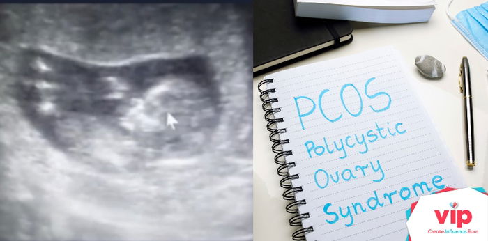 My Life Dealing With PCOS, Ovarian Cancer, and Conception