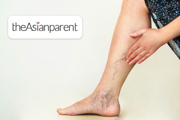All About Varicose Veins, Its Causes & Prevention Tips