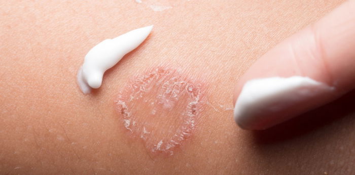 8 signs of ringworm and ways on how to cure ringworm fast