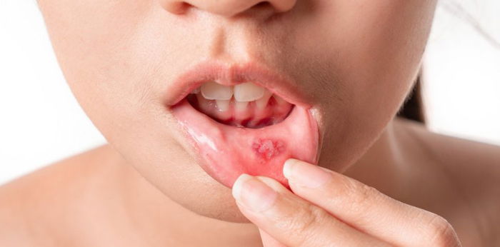 Singaw: What causes this mouth ulcer and what’s the best way to treat it?