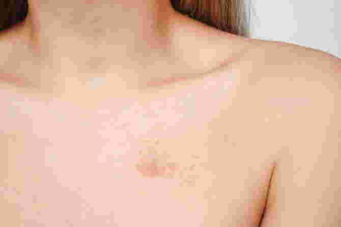 larawan ng ibat ibang uri ng sakit sa balat