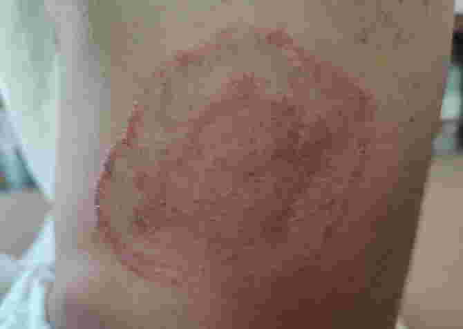 larawan ng ibat ibang uri ng sakit sa balat