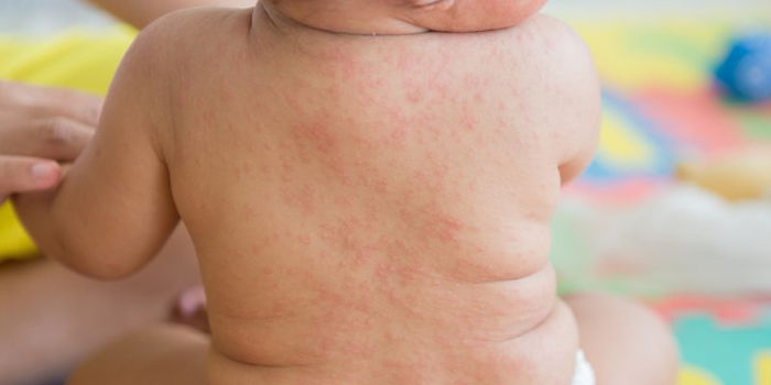 Roseola Infantum: A parent's guide to recognizing and managing this viral infection