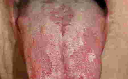 butlig sa dila - glossisitis