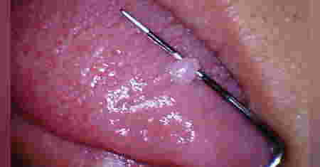 butlig sa dila - oral fibroma