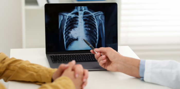 You can get lung cancer even if you don’t smoke! Check these 10 warning signs of lung cancer in women