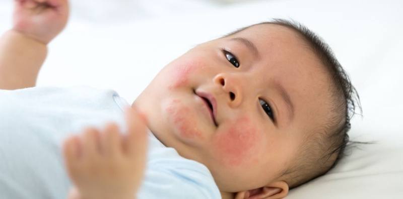 Get to Know Erythema Toxicum Neonatorum: Causes, Symptoms, and Treatment