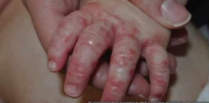 700% ang Itinaas ng HFMD Cases sa Pilipinas — Mga Dapat Malaman ng mga Magulang