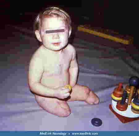 8 Mahahalagang Bagay na Dapat Tandaan Tungkol sa Meningitis at Meningococcemia