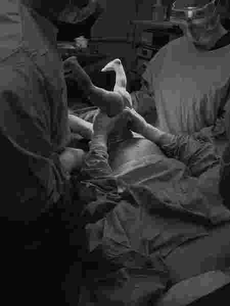 mother assisted c-section