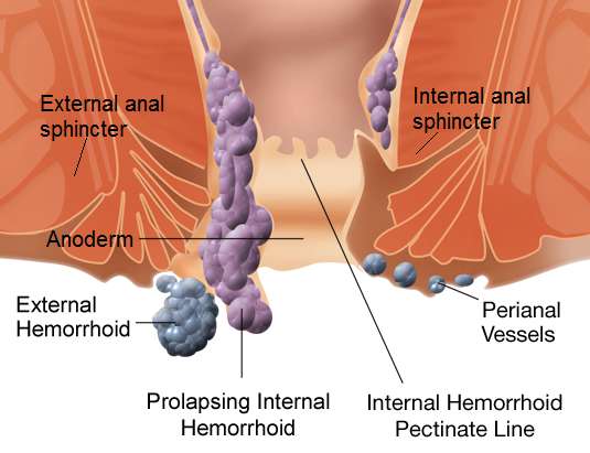 Pregnancy Concerns: Hemorrhoids AKA Piles