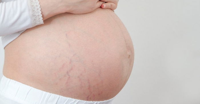 Minimize Stretch Marks in 7 Simple Steps