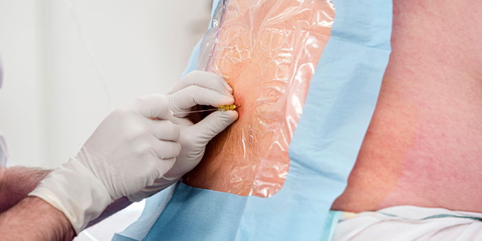 Spinal Block for Labor Pain: Benefits, Risks, and What to Expect