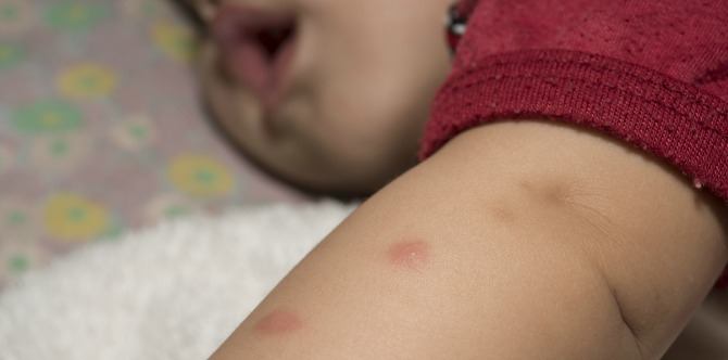 Insect Bites and Stings in Children: When Should You See A Doctor?