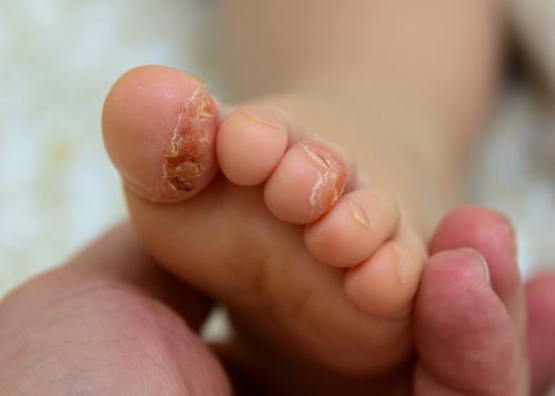 Dr Lynn Chiam on eczema and kids