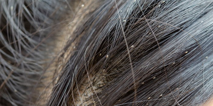 How to Get Rid of Head Lice in Your Child’s Hair!