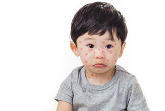 All you need to know about Chickenpox