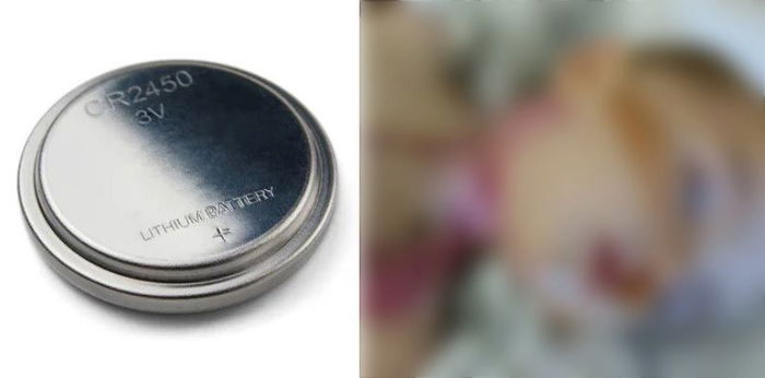8-month-old Permanently Disabled After Swallowing Battery