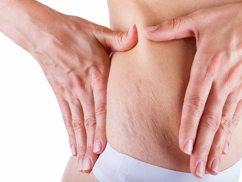 Getting rid of stretch marks after pregnancy
