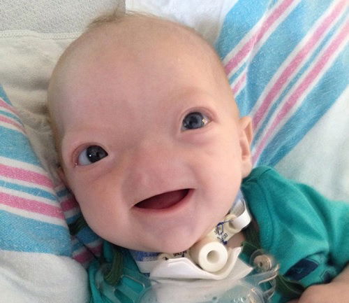 Adorable baby born without a nose: Little Eli's story