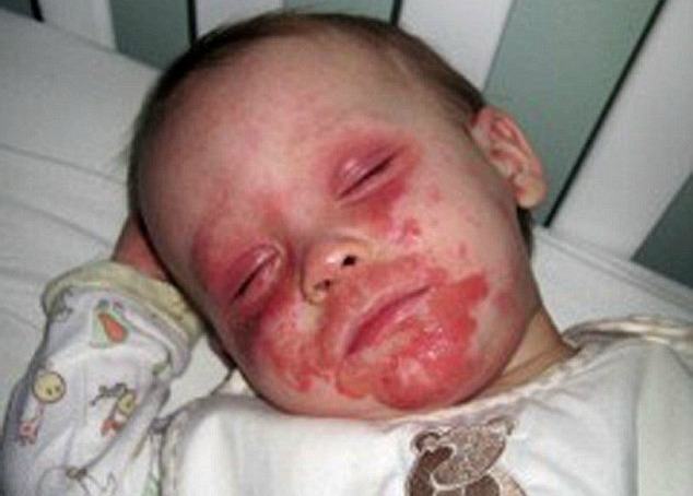 Little boy with severe eczema begs his mummy, "Please let me die"