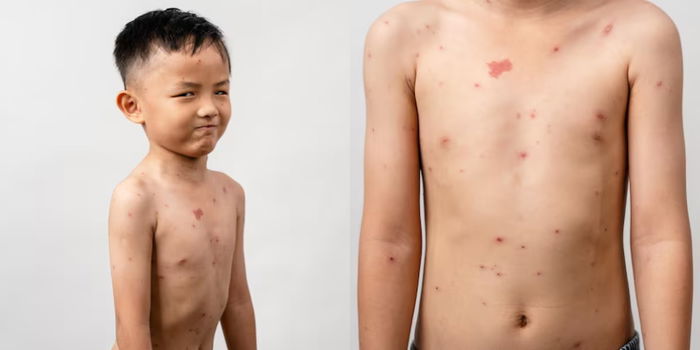 Does My Child Have Chicken Pox Symptoms?