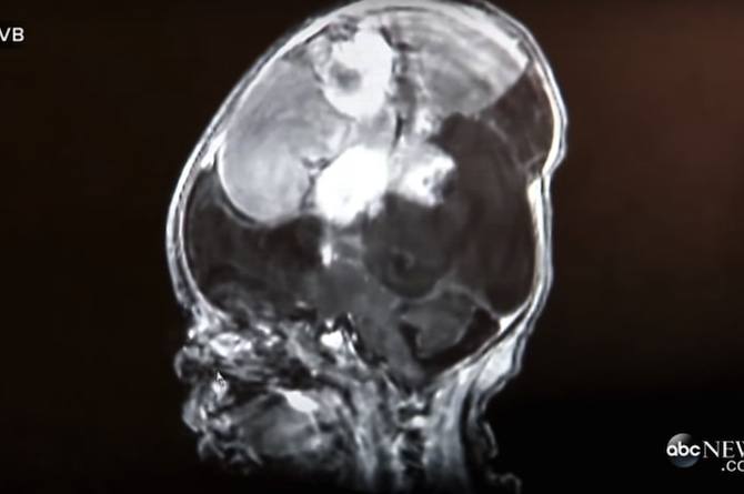 Doctors said this baby’s inoperable brain tumour would kill her at birth, but now…