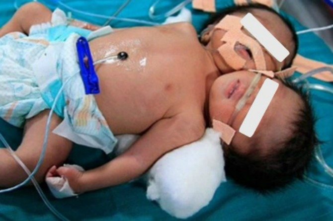 Miracle newborn conjoined twins die of heart failure