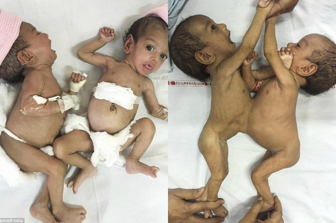 successful separation of conjoined twins